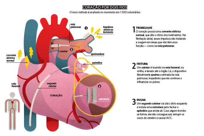 fibrilacao-nova-solucao