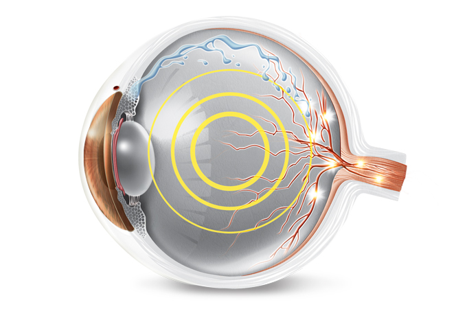 glaucoma-tratamento