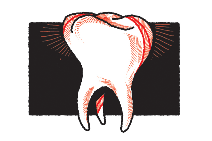 dente com cárie