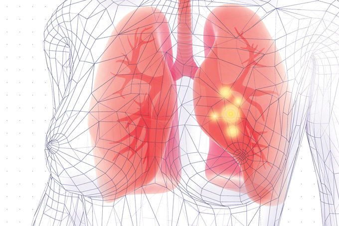 sintomas de câncer de pulmão