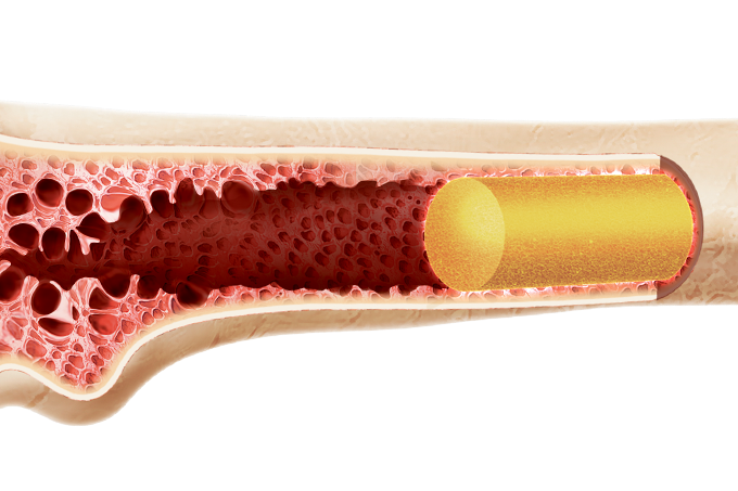 como é feito transplante de medula óssea