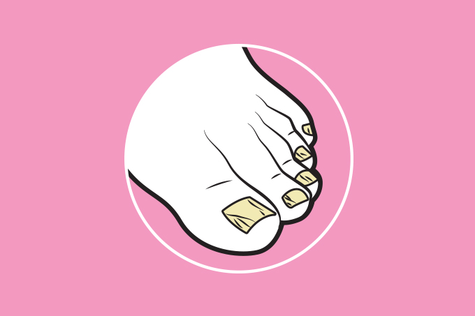 Unhas com cor estranha. Unhas com cor estranha.