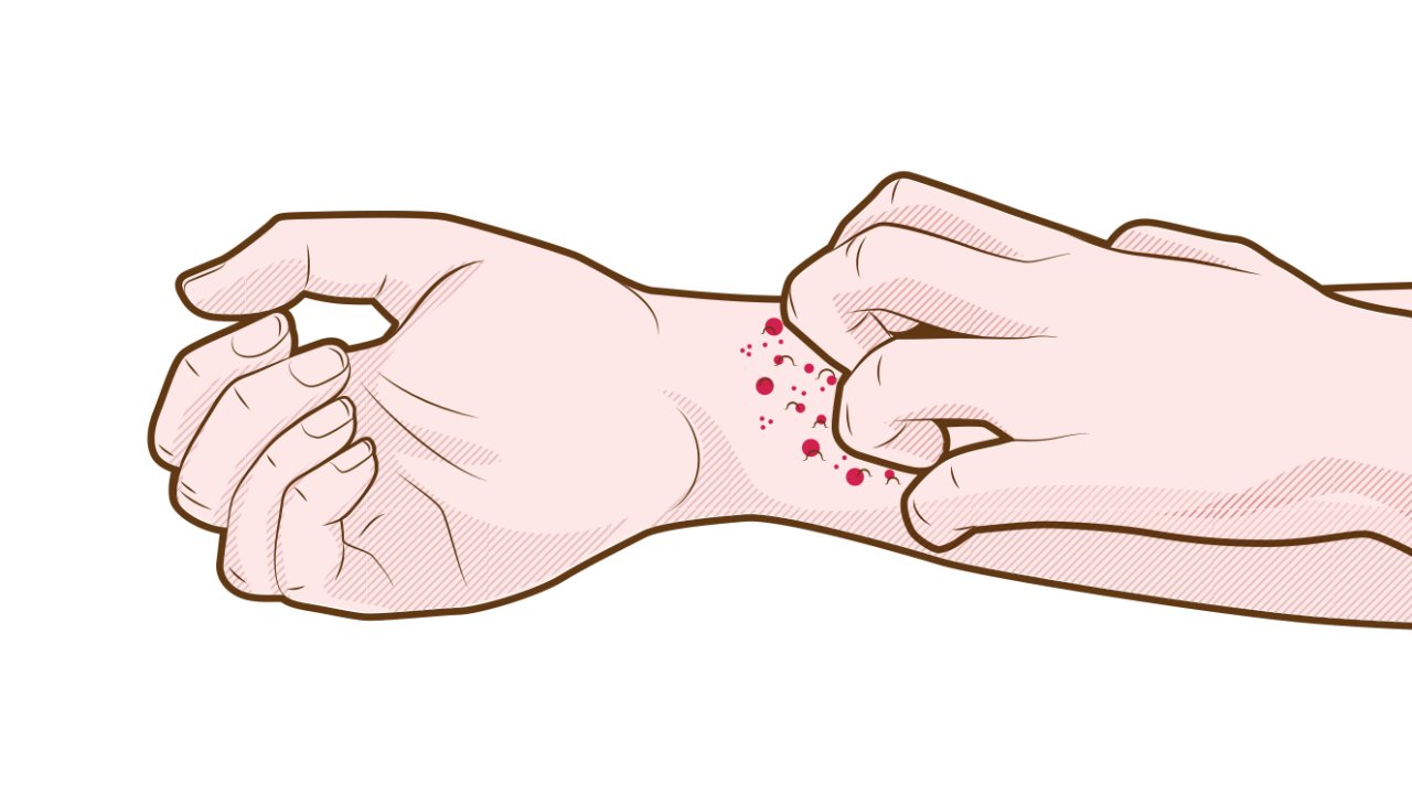 sintomas de dermatite atópica