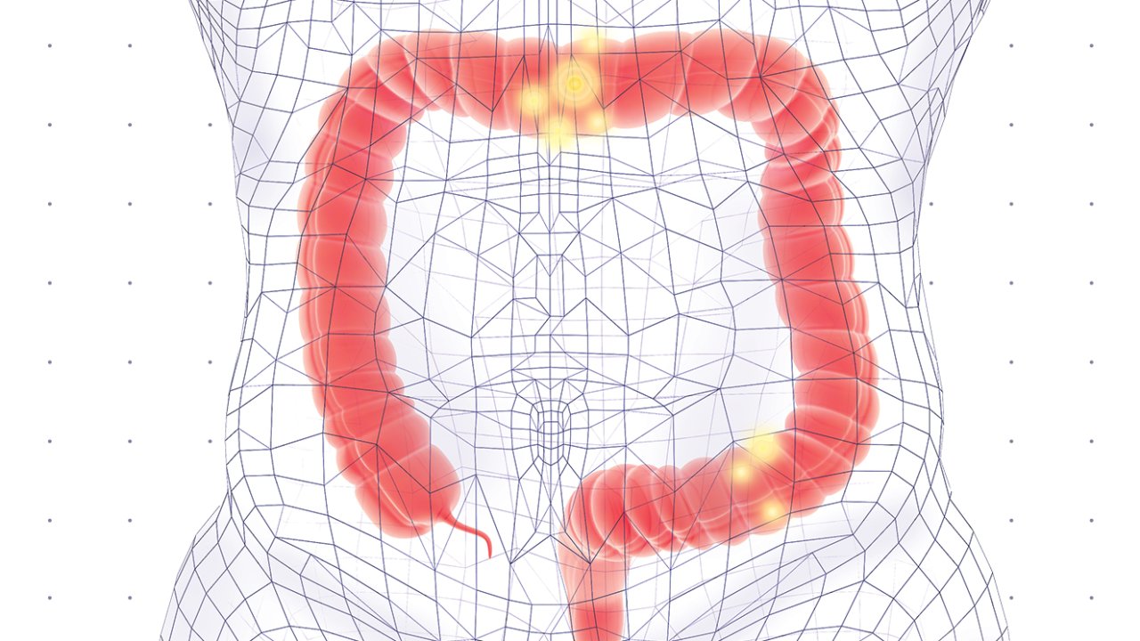 Setembro Verde: como prevenir câncer de intestino e quais os exames