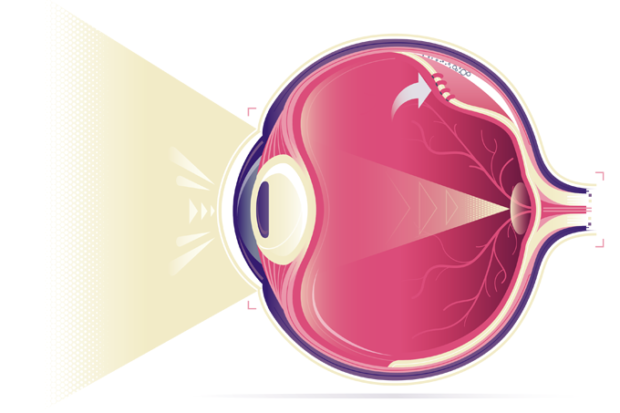 cirurgia de descolamento de retina