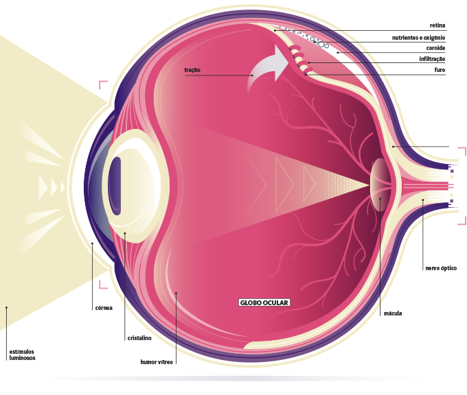 Descolamento de retina