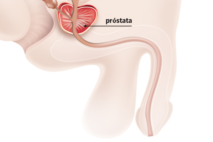 fisioterapia para câncer de próstata