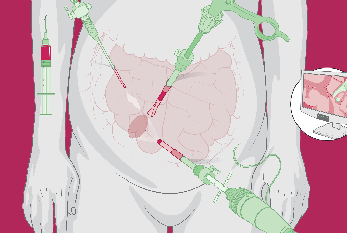 ilustração de uma barriga com instrumentos de laparoscopia, uma cirurgia