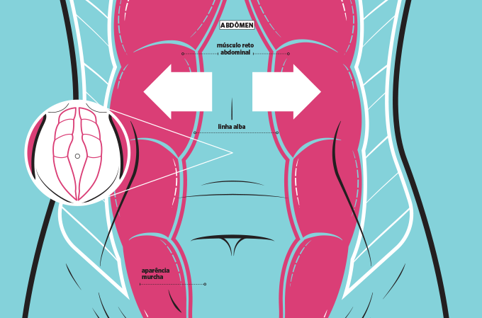 diastase-abdominal-como-acontece