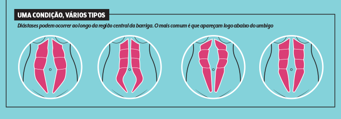 tipos-de-diastase