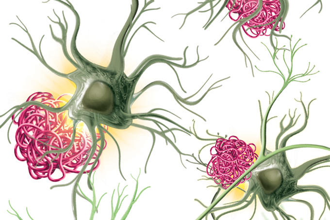 ilustração de neurônios com proteínas beta-amilode ao lado