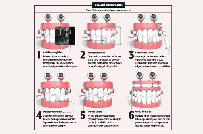 Ilustração de dentaduras mostrando o passo a passo de um implante dentário