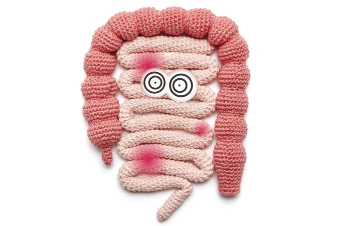 Doença de Crohn: o que é, o diagnóstico, os sintomas e o tratamento