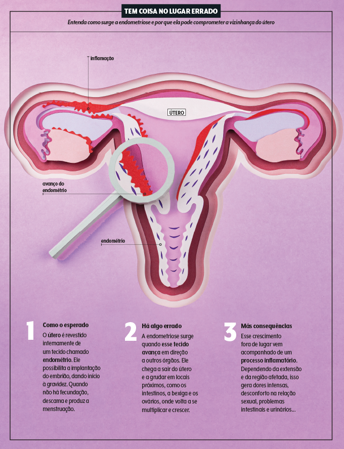 sintomas da endometriose