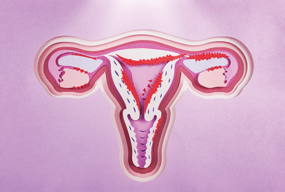 causas da endometriose