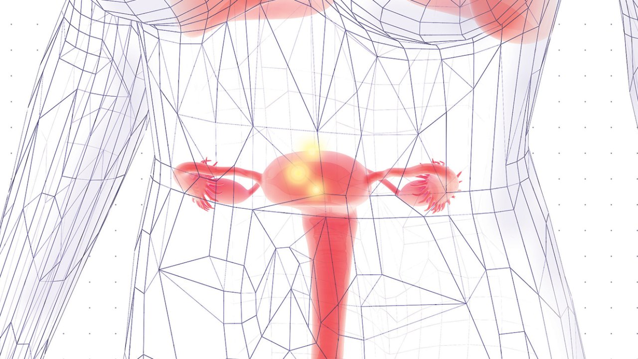 endometriose e endometrite