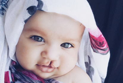 foto de bebê com lábio leporino