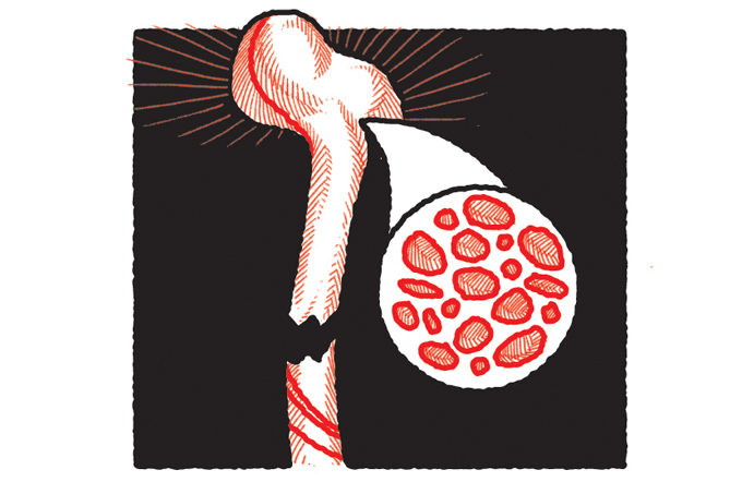 Osteoporose: a importância da prevenção de fraturas por fragilidade óssea