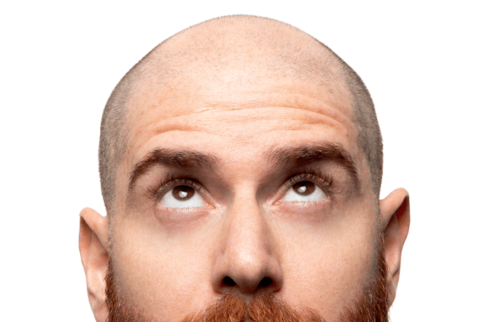 Uso de remédio para hipertensão contra a calvície divide especialistas