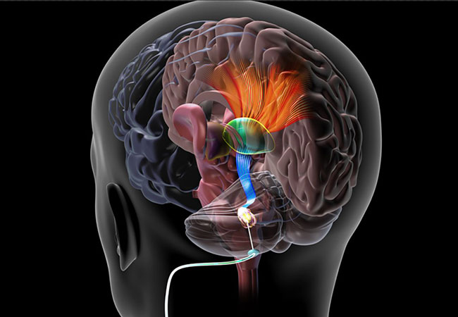 saude-neurologia-estimulacao-cerebral-profunda-avc