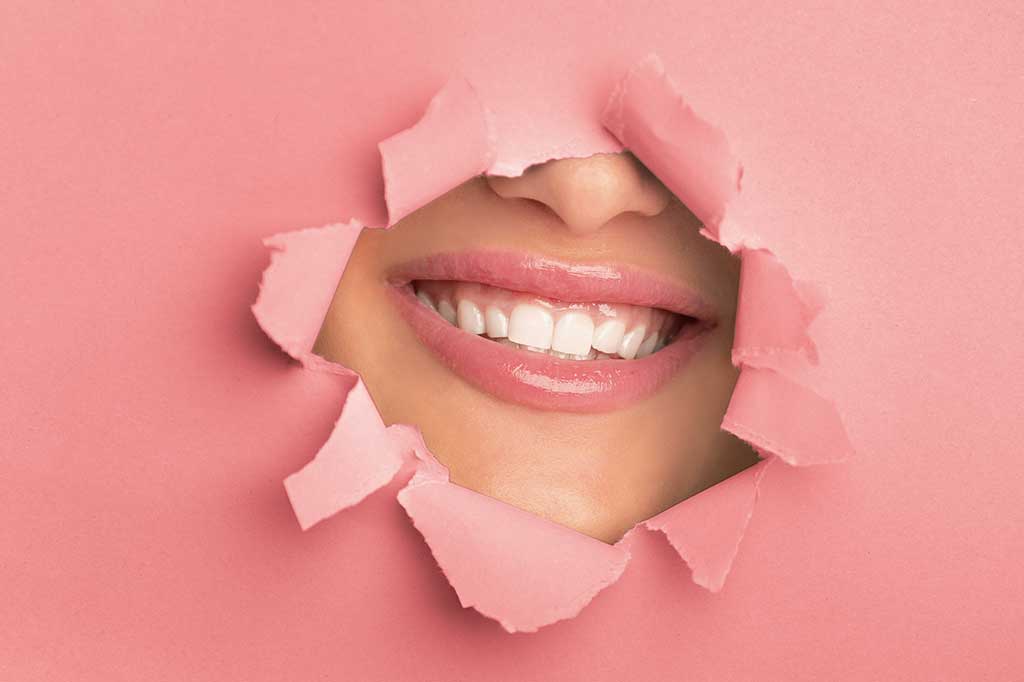 Facetas ou lentes de contato: qual o melhor para os dentes?