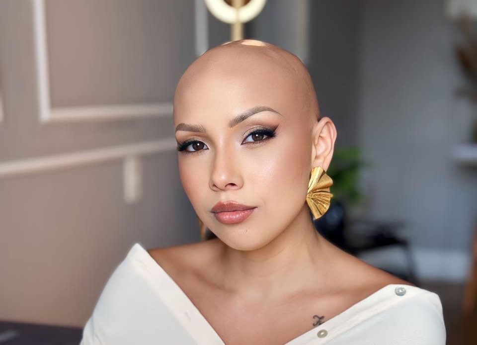 Alopecia e autoestima: a coragem de abraçar a diferença