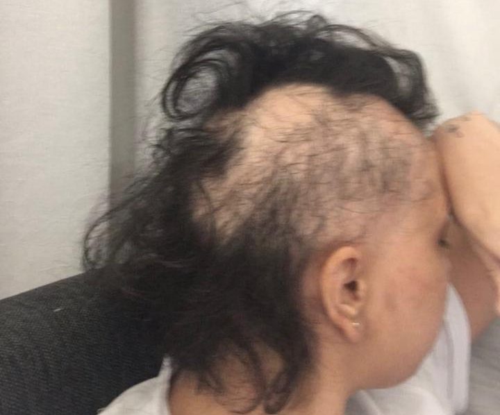 em-primeira-pessoa-alopecia-fernanda-ayub-02 em-primeira-pessoa-alopecia-fernanda-ayub-02