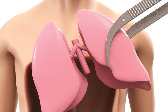como-funciona-transplante-de-orgao