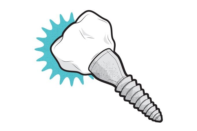 Implante dentário dói? Entenda como funciona o pós-cirúrgico