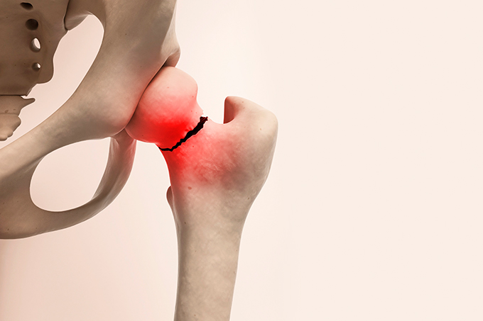 O cuidado com a saúde óssea na pós-menopausa