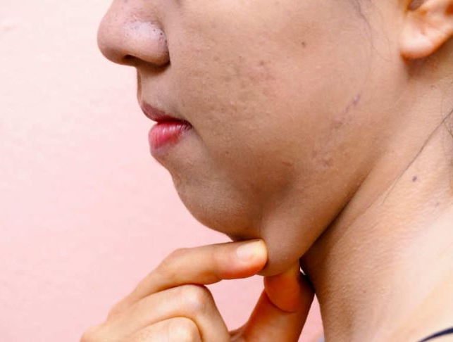 Lipo de papada: o que é, para quem é indicada e como não cair em ciladas