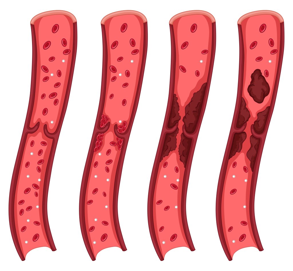 angiografia-avc-aterosclerose-como-funciona-exame-mapa-dos-vasos-sanguineos