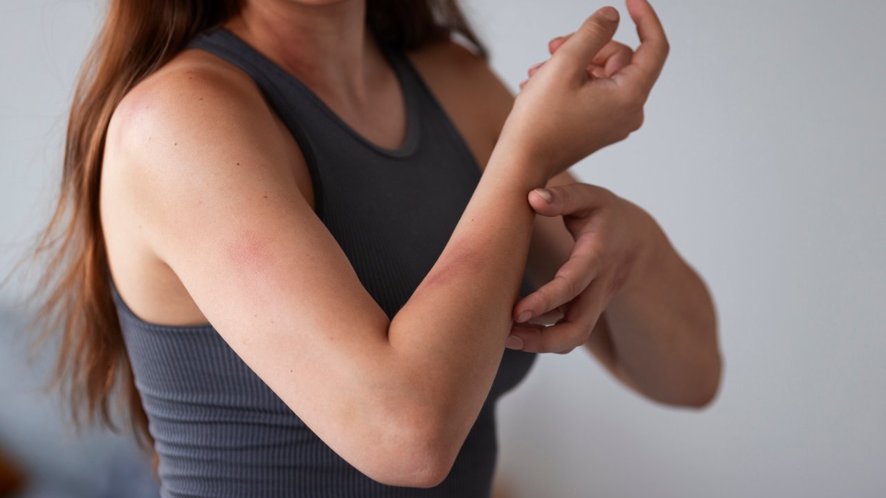 dermatite-de-contato-irritativa-alergica-sintomas-tratamento