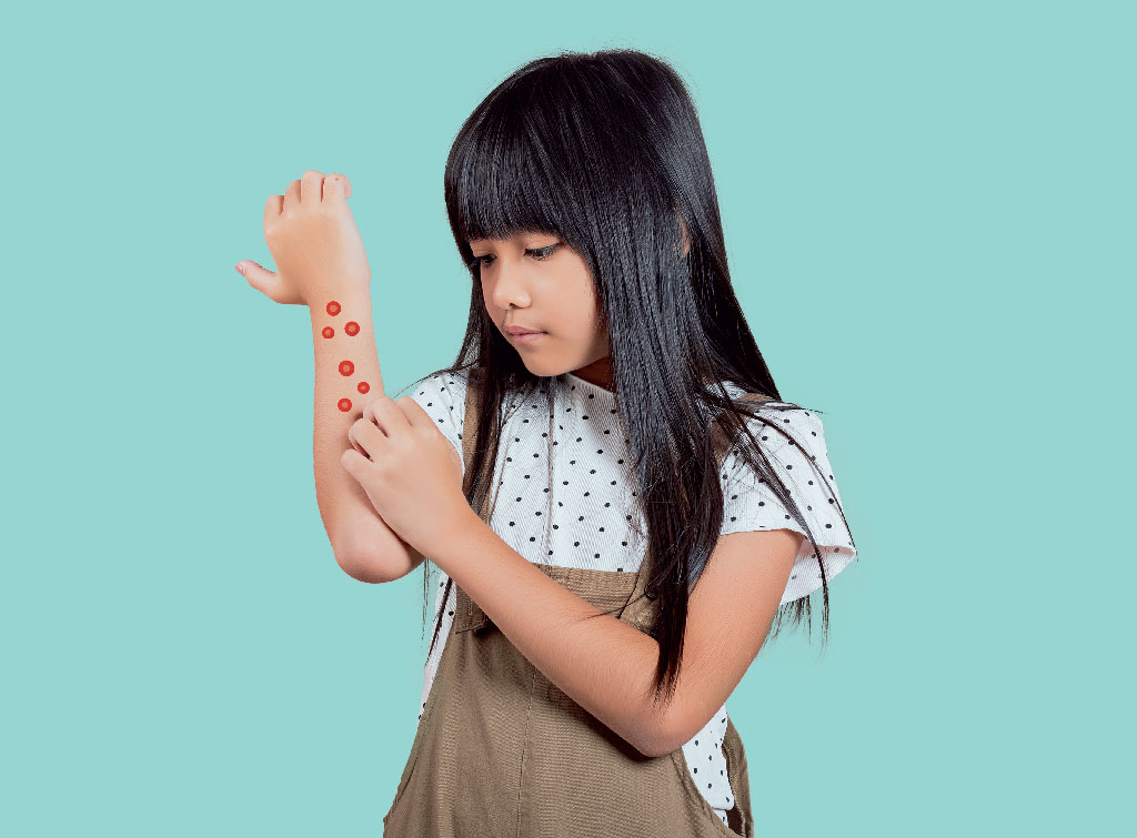 Cientistas propõem rebatizar doença conhecida como molusco contagioso